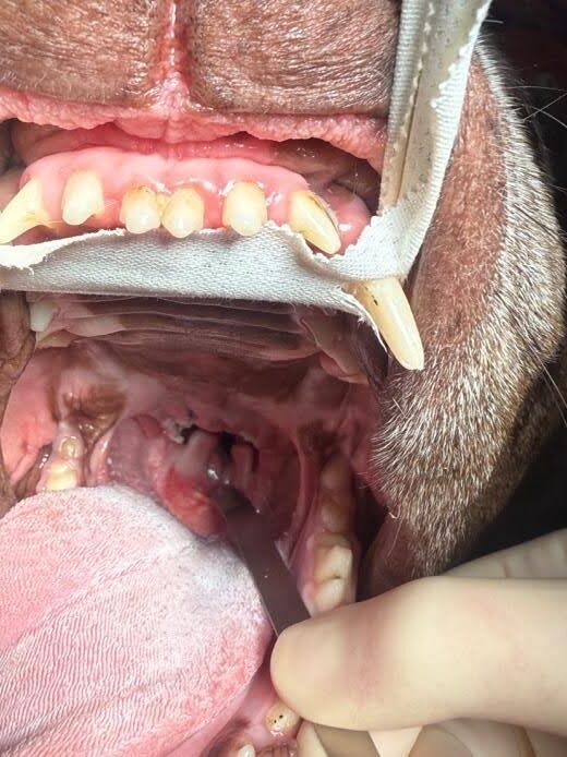 Elongated soft palate after surgical shortening